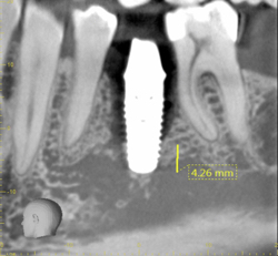 x-ray implant